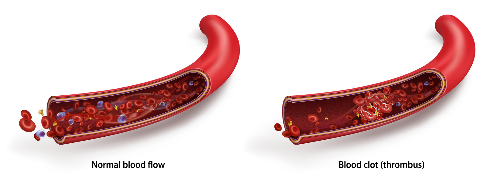 Thrombosis blood flow i Stock 1172668129 Converted 01