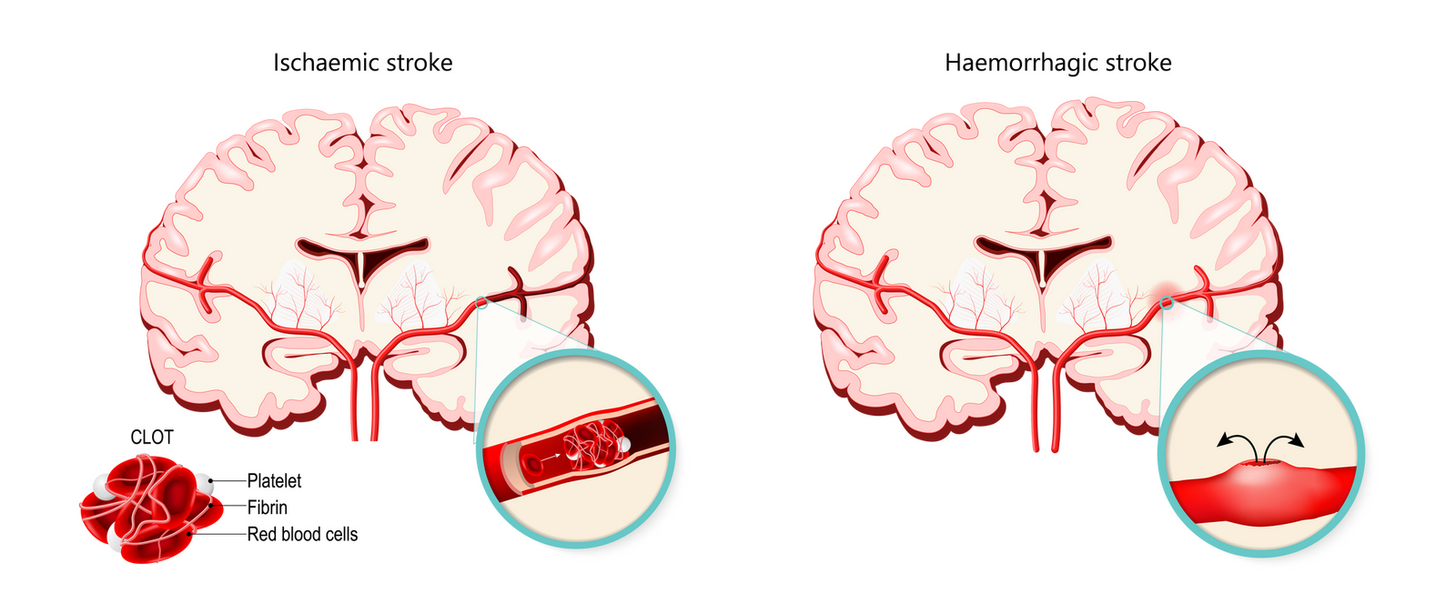 Stroke ischaemic haemorrhagic i Stock 645057360 01