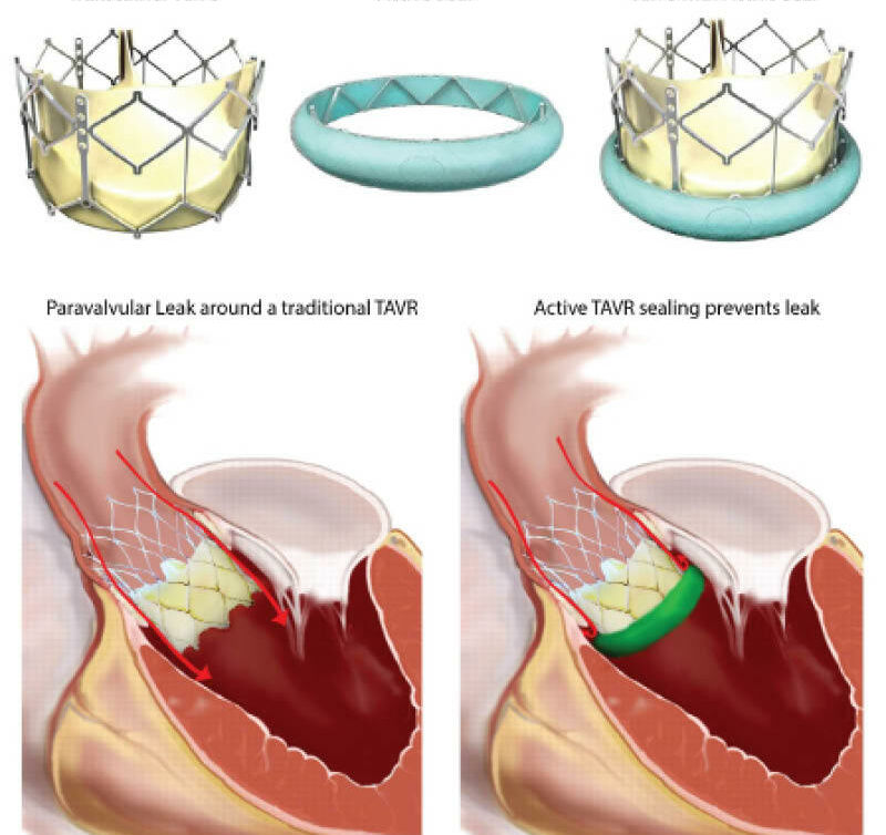 TAVI-figure-Steve-Wise-NHMRC